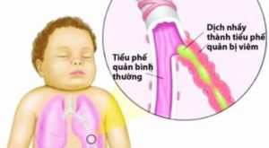 viêm tiểu phế quản trẻ nhỏ